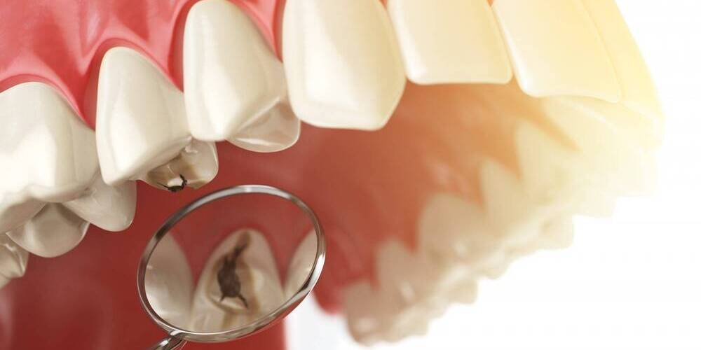 2026 Kanal Tedavisi Ücretleri Fiyatları Ne Durumda