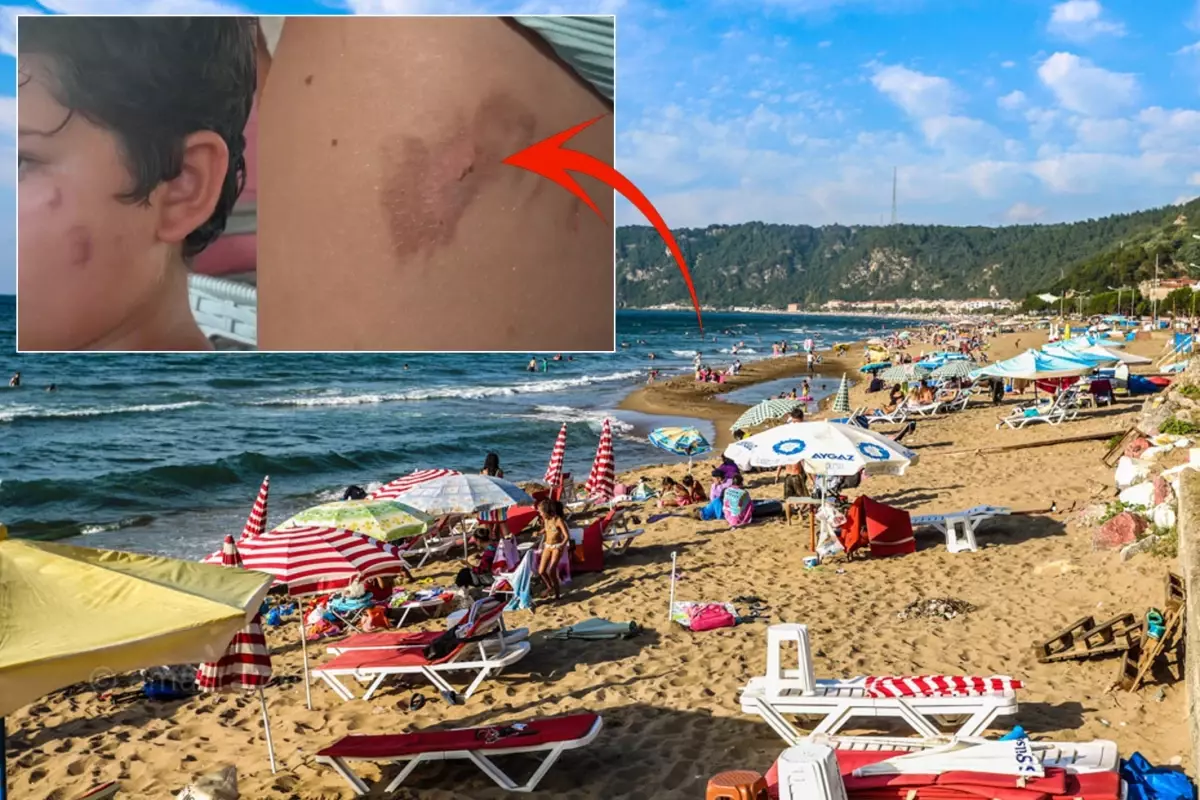 Vatandaşlar tedirgin! Denize giren yanıklarla çıkıyor