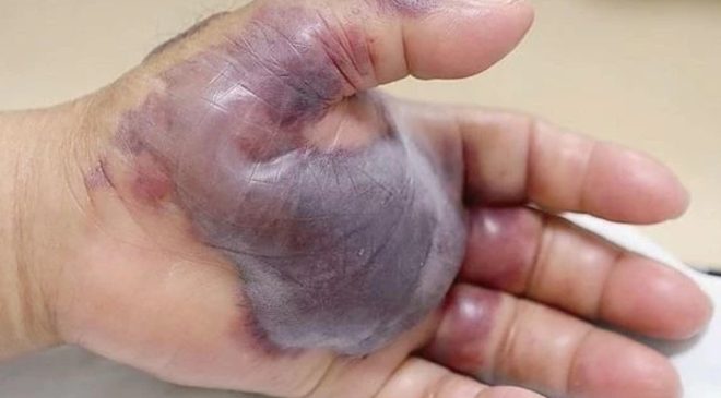 Sağlık Bakanlığı’ndan ‘vibrio bakterisi’ açıklaması